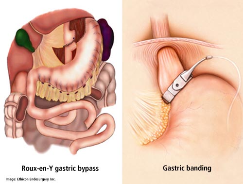 Images of gastric bypass surgery and gastric banding.