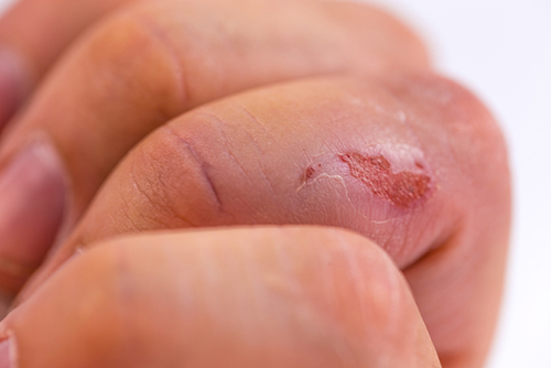 close up of a scrape on a person's finger