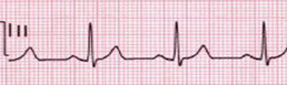 ecg