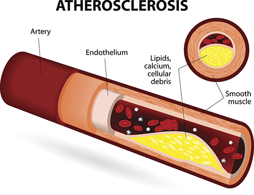 A diagram of atherosclerosis