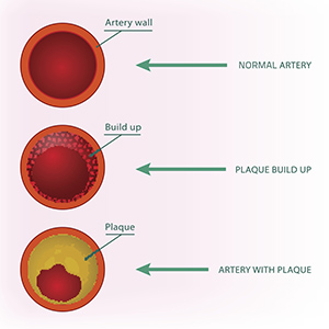 Illustration of plaque build up