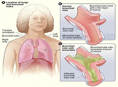 Diagram showing the lungs of a woman and a close-up of normal bronchial tubes and one with bronchitis