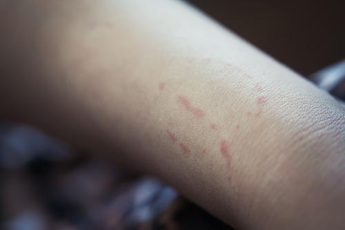 Bite marks on an arm.