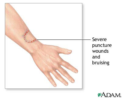 illustration of a human bite mark on a forearm with the label severe puncture wounds and bruising