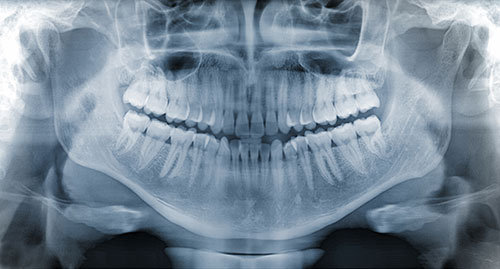 x-rays of a person's mouth