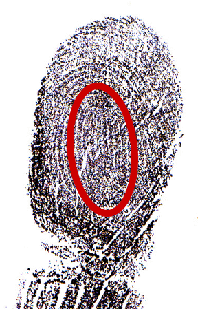 pinky thumbprint that contains a loop entering and exiting towards the thumb