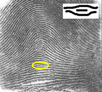 Fingerprint with a highlighted short ridge and magnified inset of short ridge pattern. 