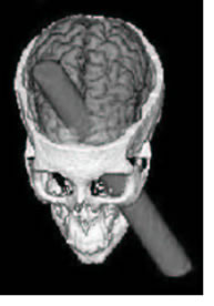 "Top view sketch of Phineas' skull with the rod"