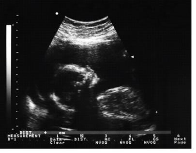 "Image of an ultrasound of a fetus"