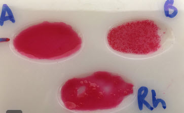 Blood sample with blood in antibody-A well smooth and uniformly red, in antibody-B blood is pinkish with small circular red clumps, and in antibody-Rh blood has think red flakes with small clear patches.