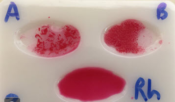 Blood sample with blood in antibody-A showing long stringy clumps in pinkish liquid, in antibody-B blood is pinkish with small circular red clumps, and in antibody-Rh the blood is smooth and uniformly red