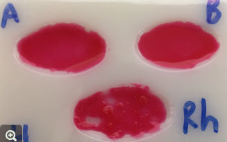 Blood sample with blood in antibody-A well that is smooth and uniformly red, in antibody-B blood is smooth and uniformly red, and in antibody-Rh blood has think red flakes with small clear patches.